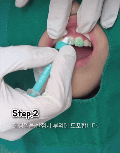 우리 아이 앞니에 하얀 반점! 소아 충치 시작의 신호? / 강남레옹치과 관련 이미지 5