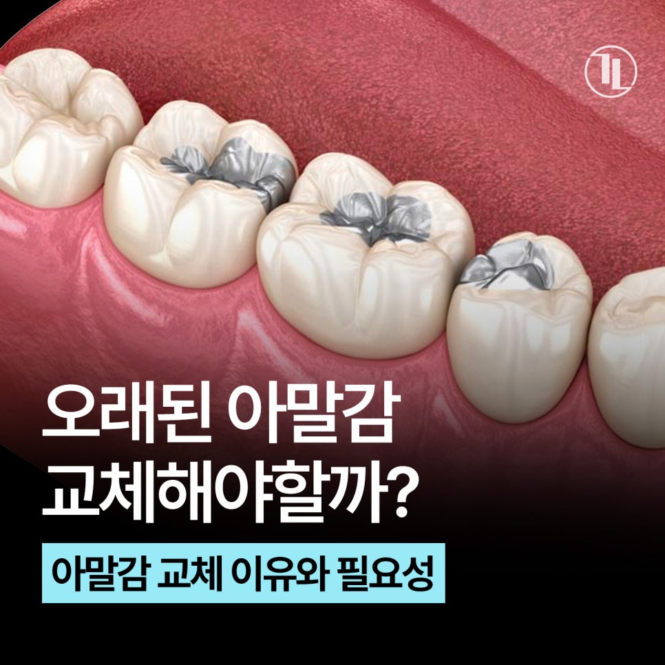 Should You Replace Dental Amalgam? Reasons and Necessity for Amalgam Replacement / Gangnam Leong Dental Clinic image 1
