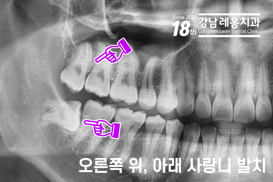 강남 레옹치과 뿌리 휘어진 사랑니 발치, 2개 한꺼번에 뽑은 사례 관련 이미지 1