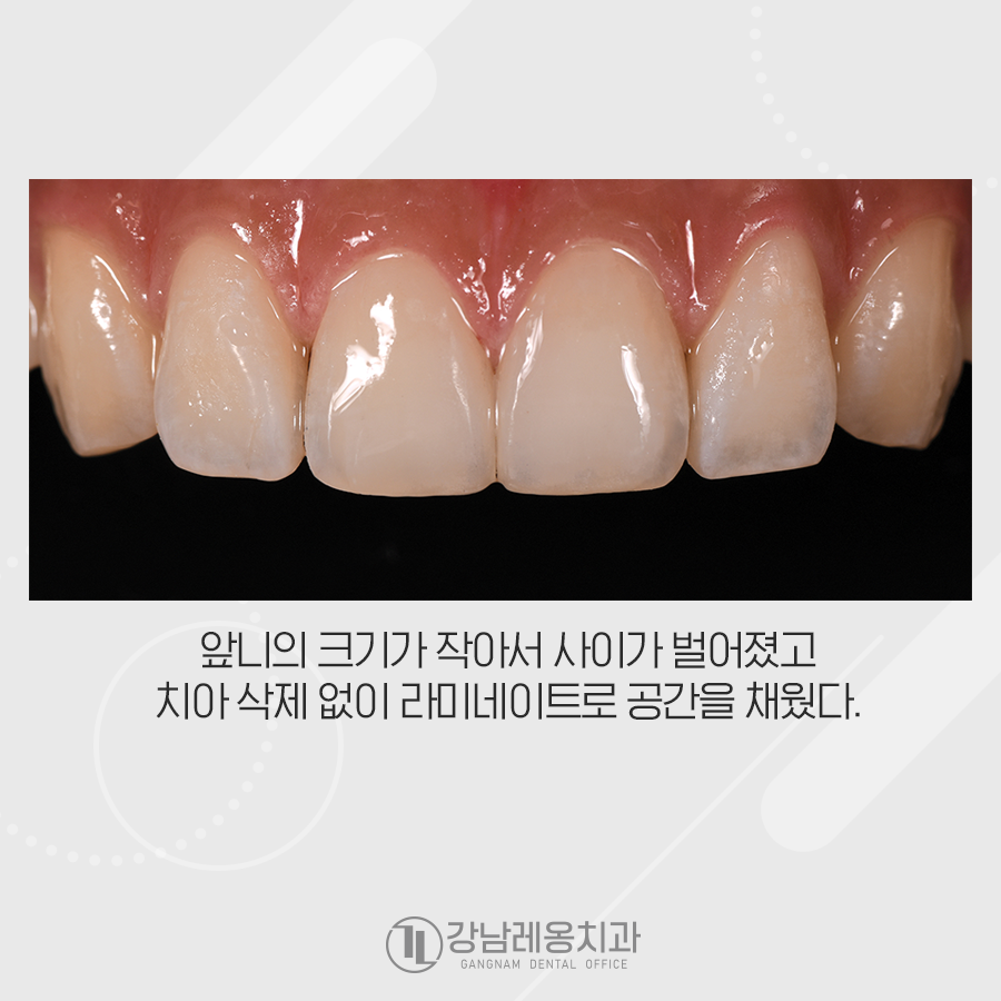 앞니 벌어짐 무삭제 라미네이트 치료는 장단점 꼭 확인! 관련 이미지 2