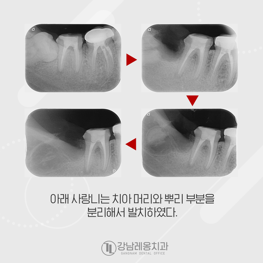 누운 사랑니 발치 통증 없이 깨끗하게 아물었던 강남레옹치과 증례 관련 이미지 4