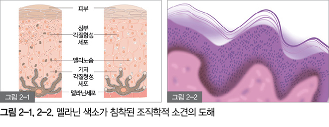 잇몸도 화이트닝이 된다? 까만 잇몸, 착색 잇몸 미백 / 강남레옹치과 관련 이미지 2