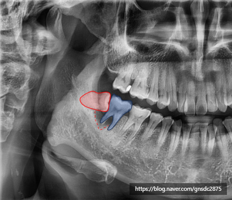 사랑니 통증, 약 먹으며 방치하면 안되는 이유! 실제 방치 사례🔍 / 강남레옹치과 관련 이미지 6