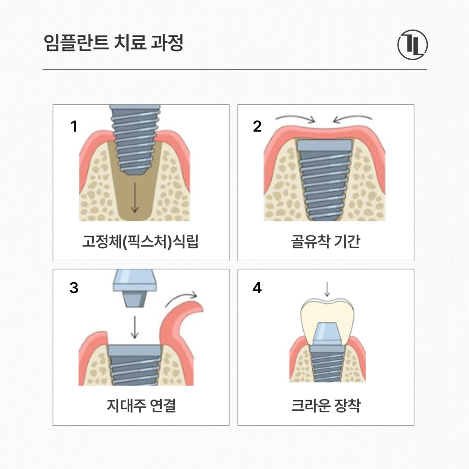 Full-Mouth Implant Treatment Case for Extensive Tooth Loss / Gangnam Leon Dental Clinic image 4