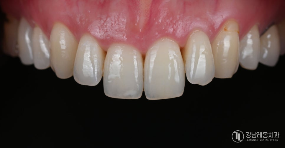 앞니 끝이 살짝 깨졌다면? 뉴티스 치아성형으로 자연스럽게 치아라인 정리하기 관련 이미지 4