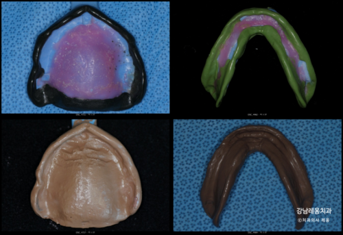만 65세 이상 틀니 보험적용 혜택과 과정💫 / 보훈위탁병원 강남레옹치과 관련 이미지 4