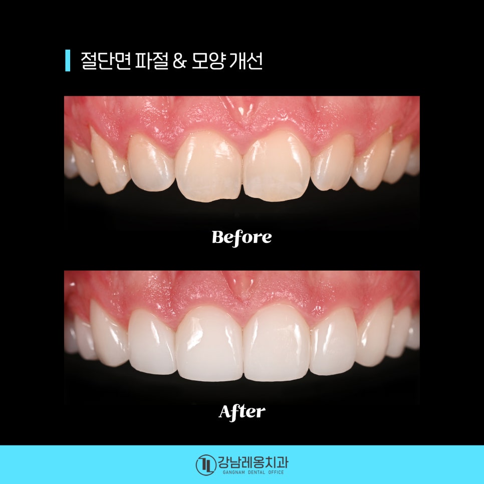 최소삭제 라미네이트 &lsquo;뉴티스&rsquo;의 시술 후 관리방법은? / 양치질, 치실 사용방법 / 강남레옹치과 관련 이미지 2