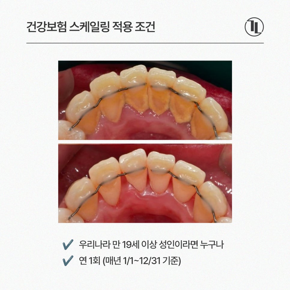올해 스케일링 아직 안 하셨나요? / 연 1회 스케일링 혜택 비용 / 강남레옹치과 관련 이미지 3
