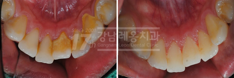 올바른 잇솔질이 왜 중요한지 예방중심 강남역치과의 설명 관련 이미지 3