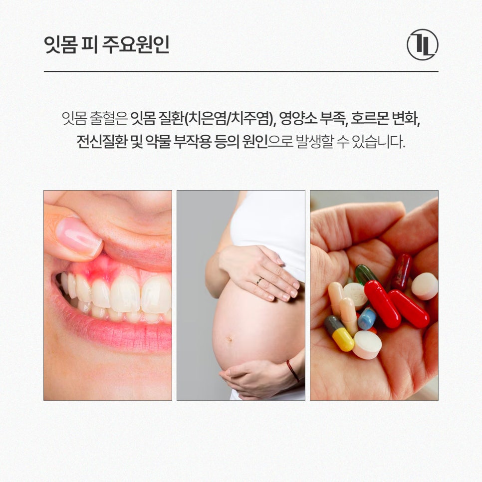 잇몸에서 피나는 사람들의 공통된 습관 4가지? / 잇몸 피 예방법 / 강남레옹치과 관련 이미지 4