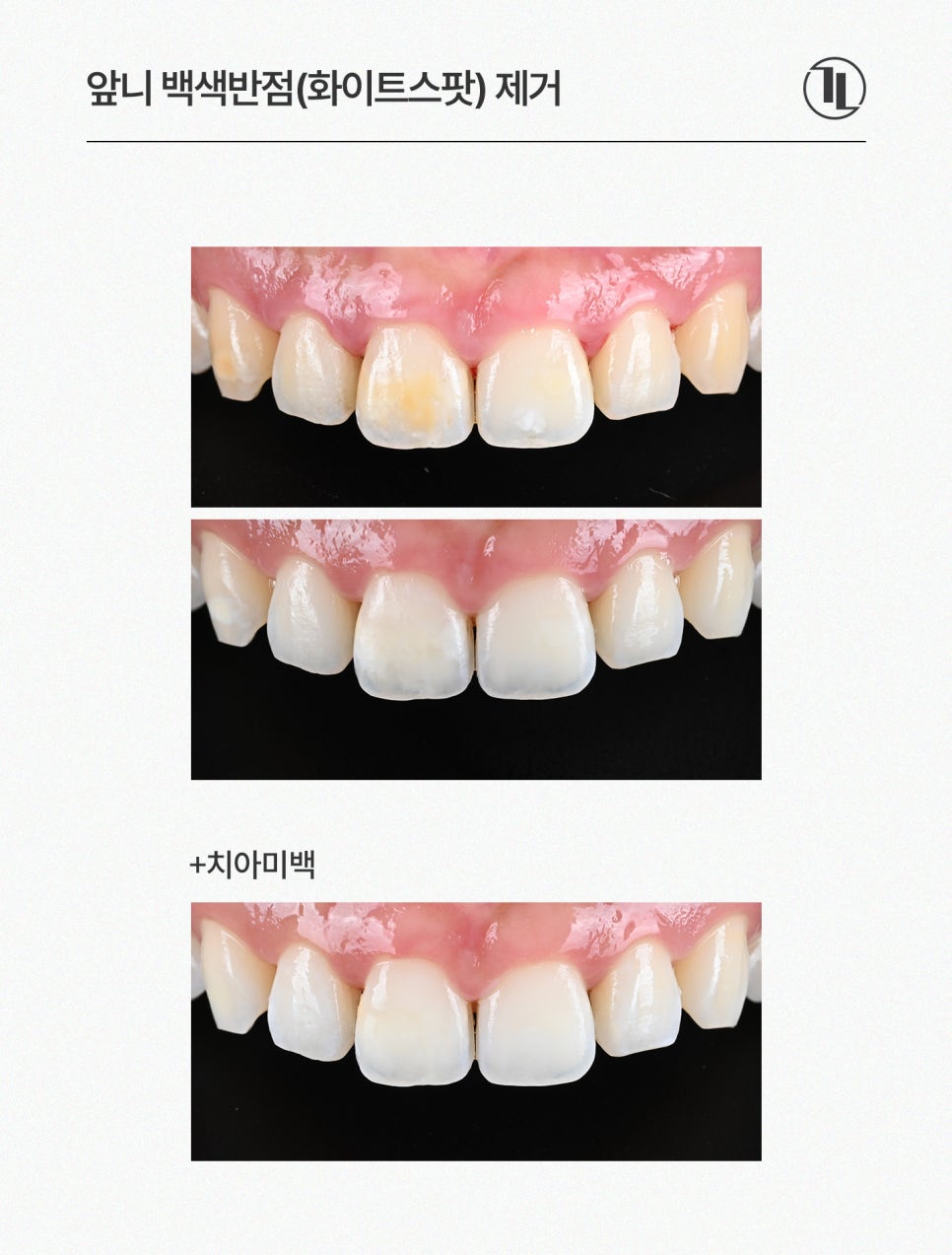 앞니 하얀얼룩 반점치 하루만에 치료, 원인과 사례까지! / 강남레옹치과 관련 이미지 6