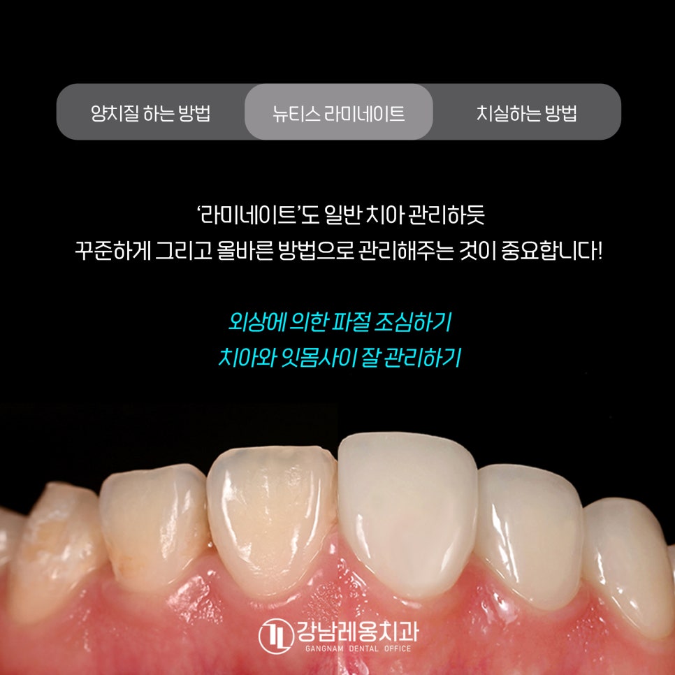 최소삭제 라미네이트 &lsquo;뉴티스&rsquo;의 시술 후 관리방법은? / 양치질, 치실 사용방법 / 강남레옹치과 관련 이미지 9