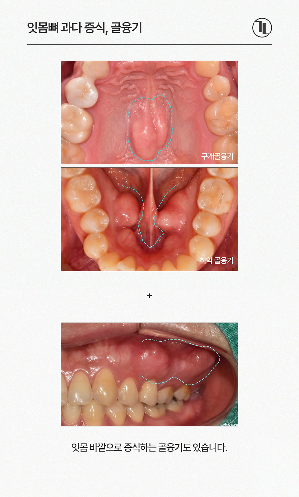 입안에서 느껴지는 딱딱한 이물감? 잇몸뼈 돌출 골융기 제거 / 강남레옹치과 관련 이미지 2