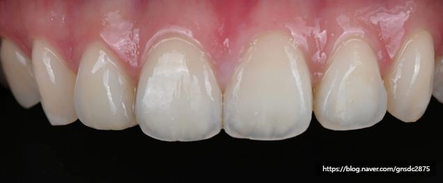 앞니에 하얀얼룩이? 앞니 길이가 달라요! / 앞니통합치료 뉴티스 반점치료 + 치아성형✨ / 강남레옹치과 관련 이미지 11
