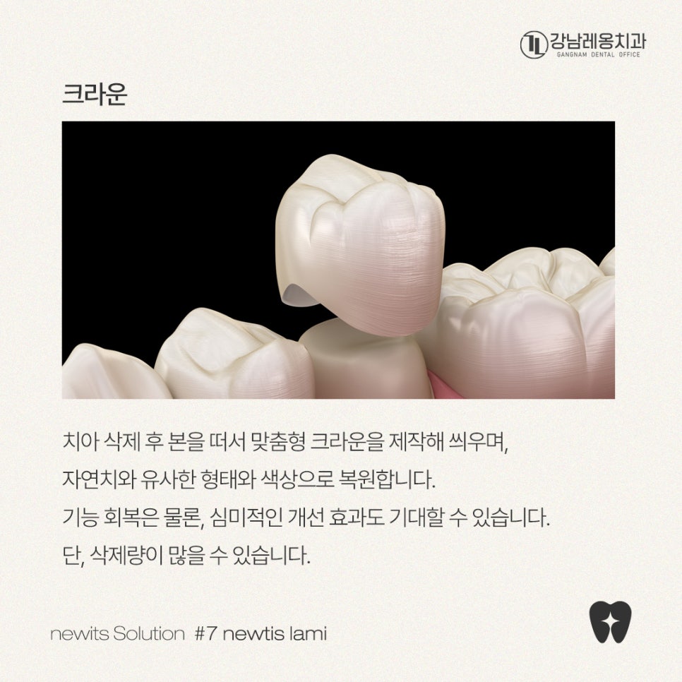 치아파절 개선방법, 뉴티스라미✨ / 강남레옹치과 관련 이미지 3
