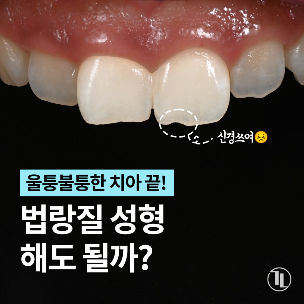 깨진 앞니 길이가 긴 앞니, 법랑질 성형 알아보기🔎 / 강남레옹치과의원 관련 이미지 1