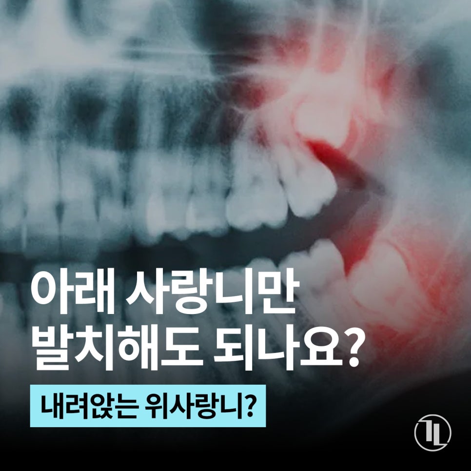 아래 사랑니만 발치해도 괜찮을까? 강남역 사랑니발치 /  강남레옹치과 관련 이미지 1