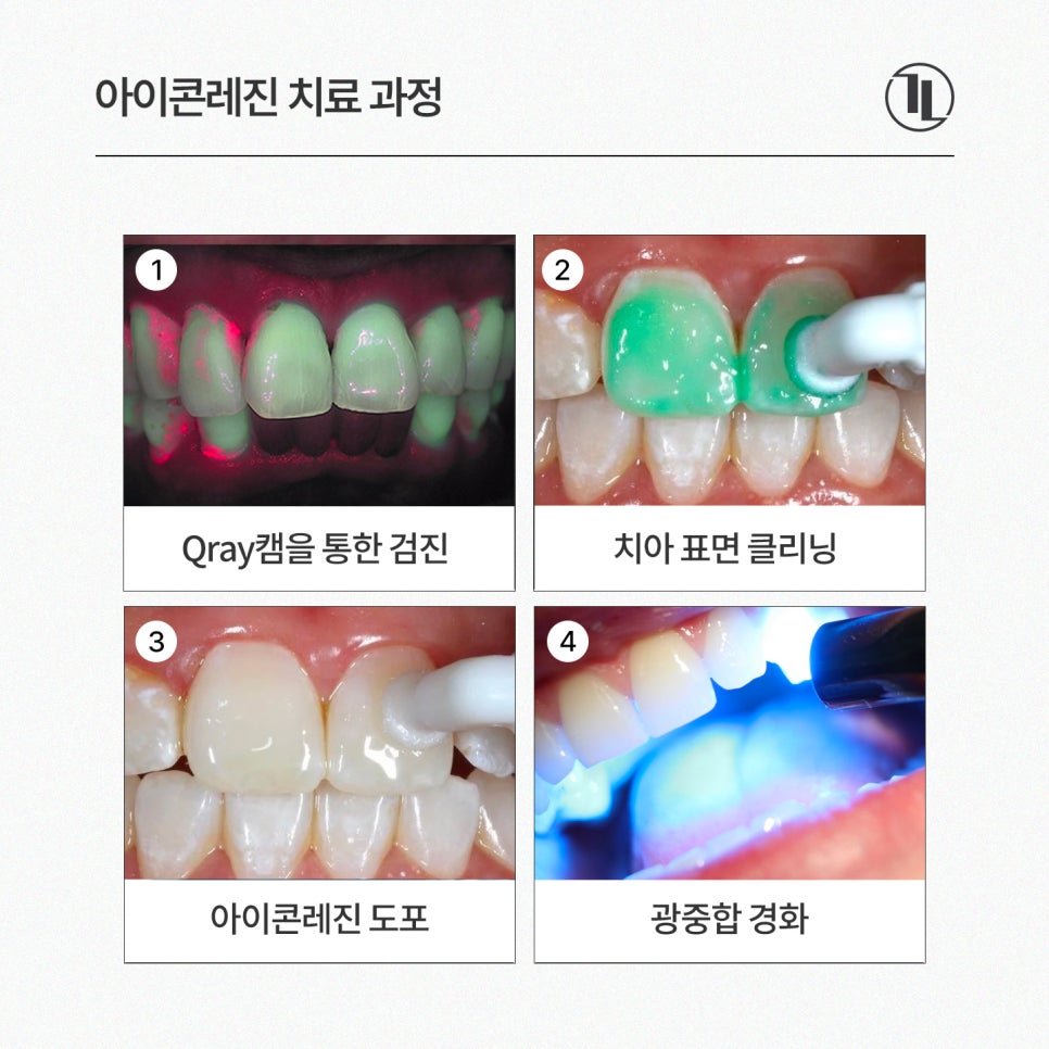 Must Check Before Treating White Spots / Icon Resin Features, Process, and Precautions / Gangnam Leen Dental Clinic image 5