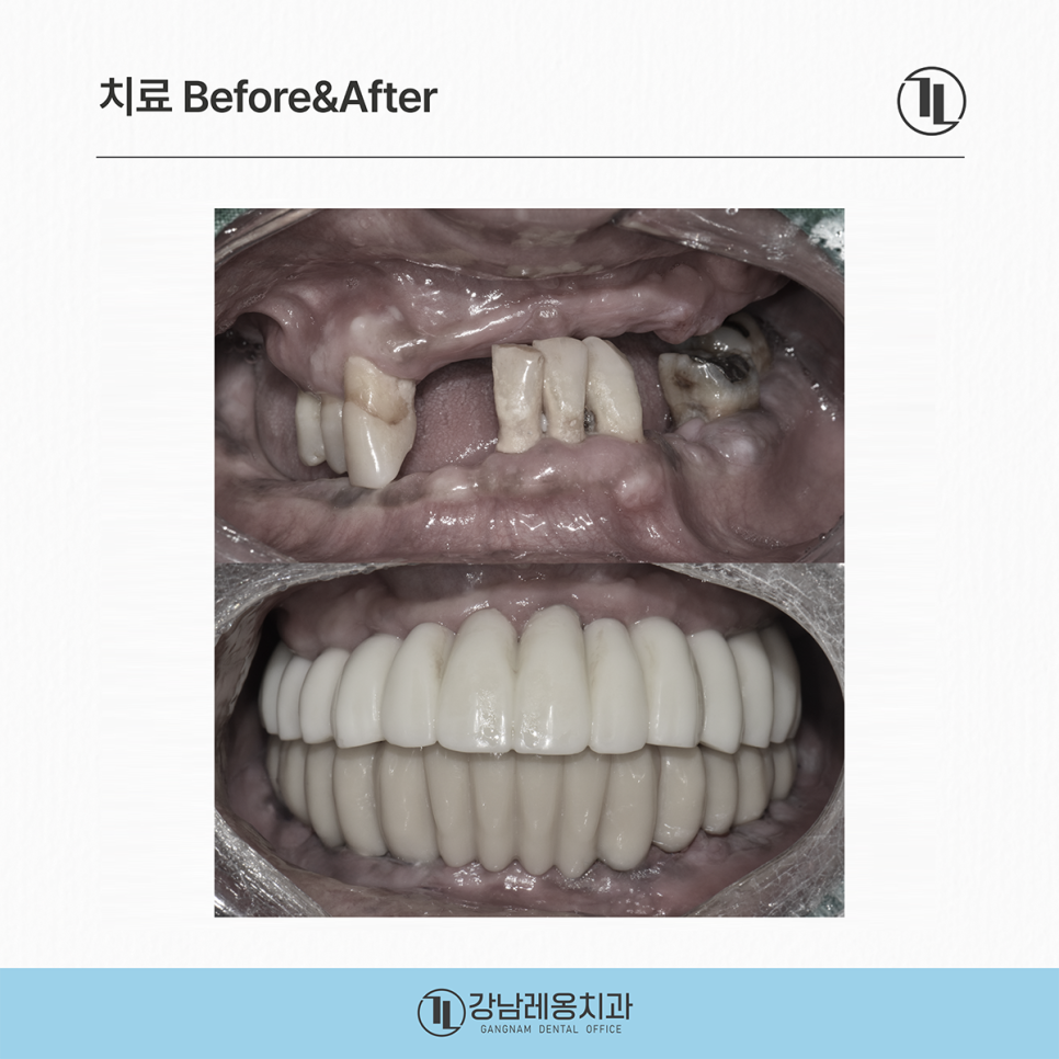 Full-Mouth Implant Treatment Case for Extensive Tooth Loss / Gangnam Leon Dental Clinic image 5