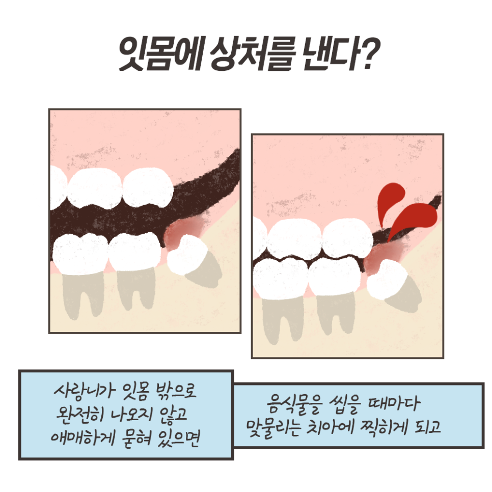 사랑니 발치 이유!! 최악의 경우 이렇게까지 된다..? (냐폴레옹툰 7화) 관련 이미지 6