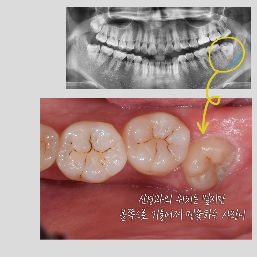 사랑니 발치 전문 레옹의 치료사례, 신경이 가깝거나 멀거나 관련 이미지 4