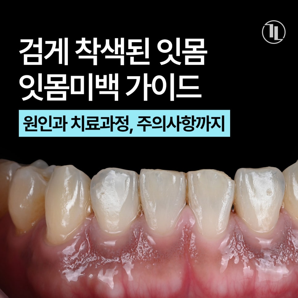 검은 잇몸, 원인부터 잇몸미백 치료과정, 주의사항까지 한눈에 보기👀 / 강남레옹치과 관련 이미지 1
