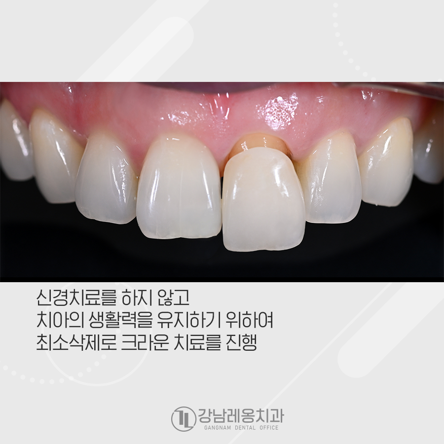 오래된 레진 변색, 강남레옹치과에서 앞니 크라운 치료 관련 이미지 2
