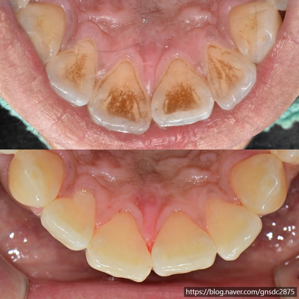 커피&middot;담배치아 착색! 에어플로우로 제거⚡ / 강남레옹치과 관련 이미지 5