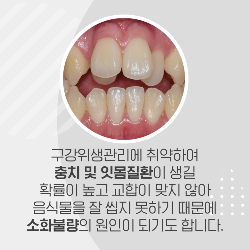 여름방학, 강남레옹치과에서 치아교정 할 타이밍! 관련 이미지 7