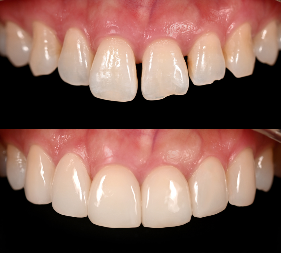 즐거운 학교 생활을 위한 강남역치과 제안~! 관련 이미지 3