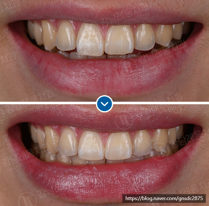 뉴티스 치아성형✨ 살짝 깨진 앞니, 뾰족한 송곳니 다듬기 / 강남레옹치과 관련 이미지 3