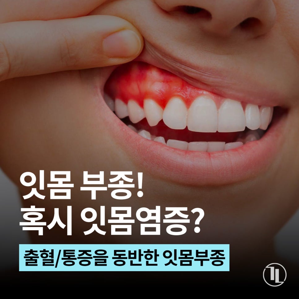 잇몸이 부었다면? 잇몸염증&middot;피 동반 시 조심해야 할 3가지 습관 / 강남레옹치과 관련 이미지 1