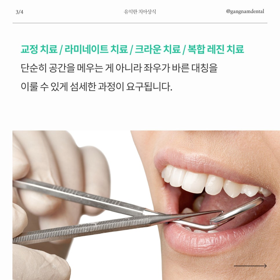 치아 벌어짐 / 앞니 사이 간격 넓어짐 / 정중이개 원인의 증상 그리고 개선할 수 있는 방법에 대해 관련 이미지 4