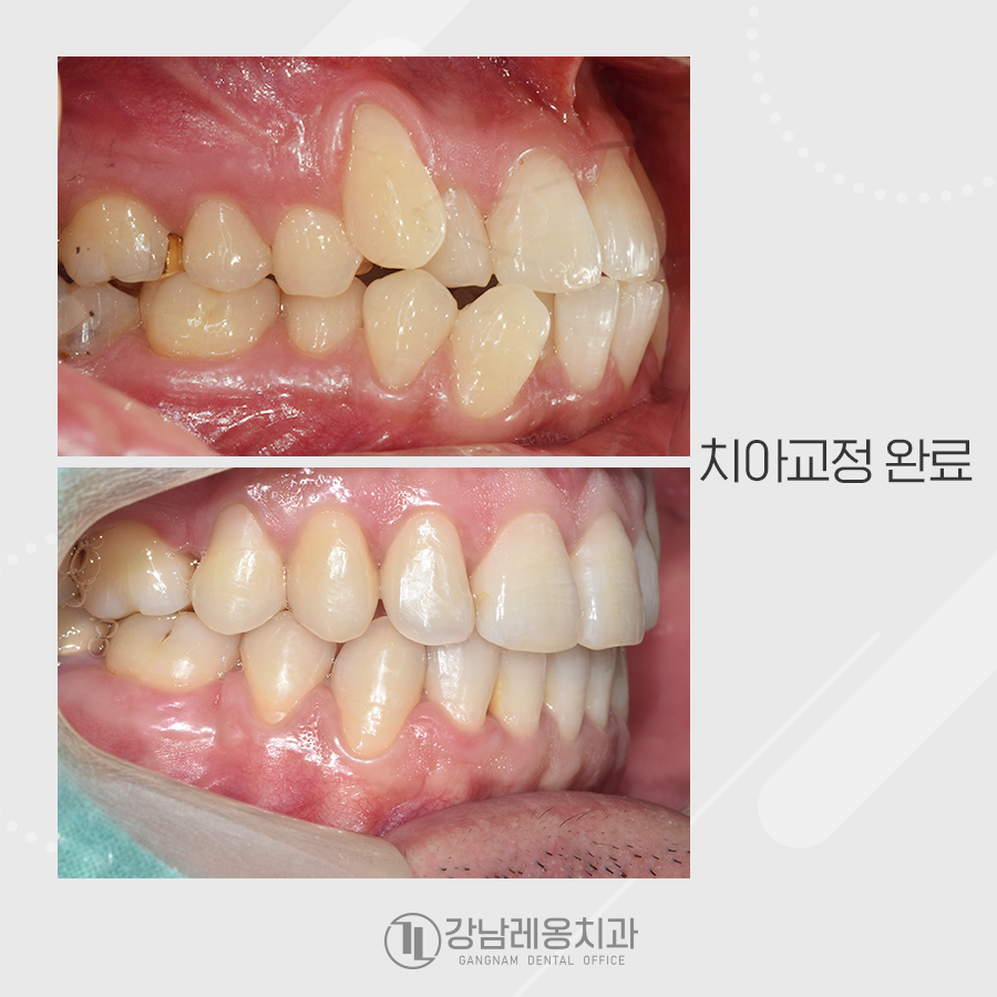 발치 치아교정, 덧니 총생 반대교합까지 한번에 해결 관련 이미지 5