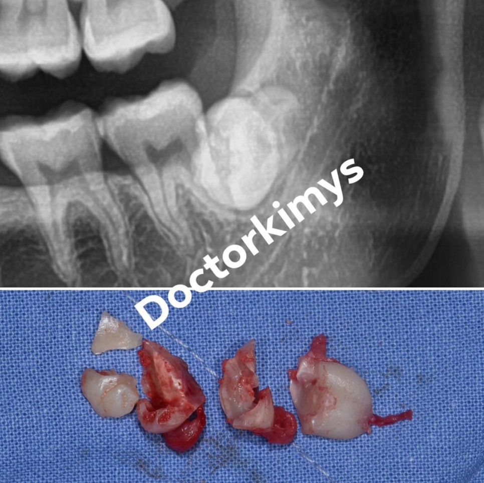 치과의사도 뽑으러 오는 사랑니 발치 전문 강남레옹치과! 관련 이미지 4