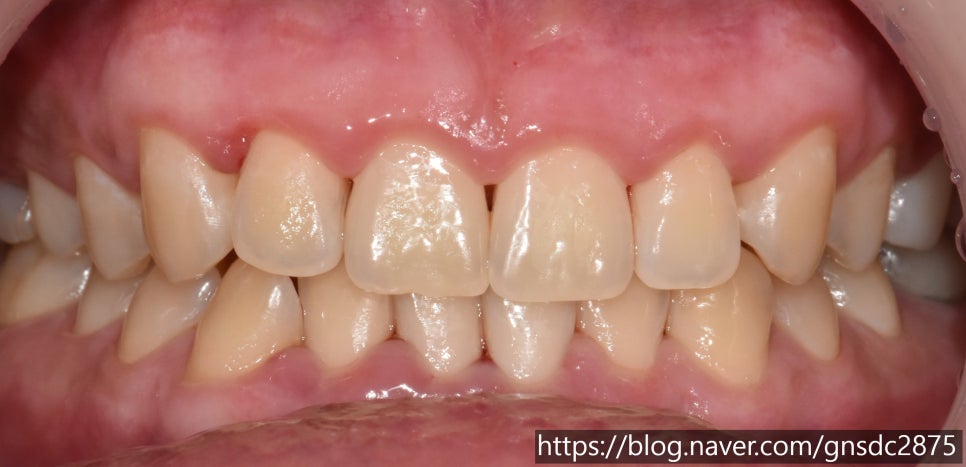 뉴티스 잇몸미백✨ 웃을 때 드러나는 검은 잇몸 개선 / 강남레옹치과 관련 이미지 6