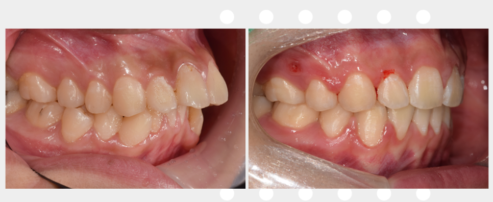 앞니 뻐드러짐 치아 교정으로 돌출입 들어간 케이스 관련 이미지 3