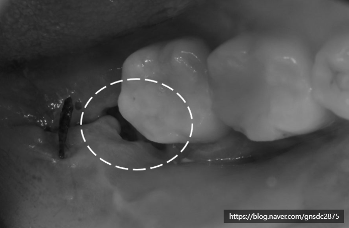 사랑니 발치 후 구멍, 음식물 끼임부터 회복, 관리법까지 총정리📑 / 강남레옹치과 관련 이미지 4