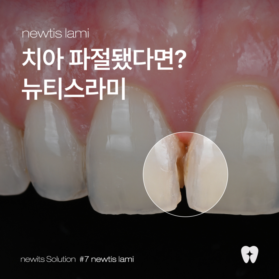 치아파절 개선방법, 뉴티스라미✨ / 강남레옹치과 관련 이미지 1