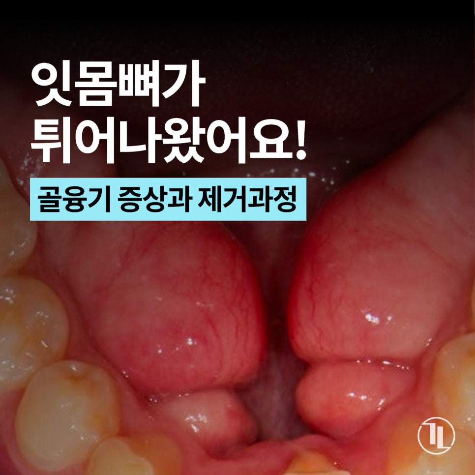 입안에서 느껴지는 딱딱한 이물감? 잇몸뼈 돌출 골융기 제거 / 강남레옹치과 관련 이미지 1