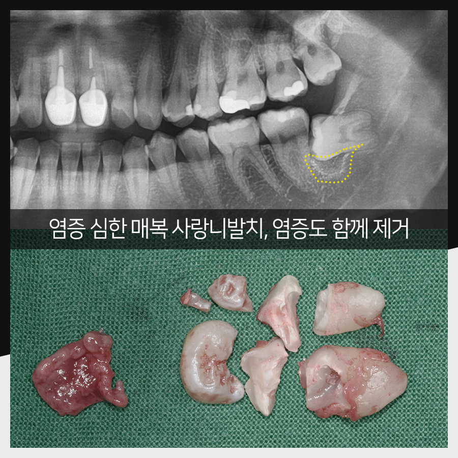 강남레옹치과 사랑니 발치, 결과가 증명해주는 실력! 관련 이미지 21