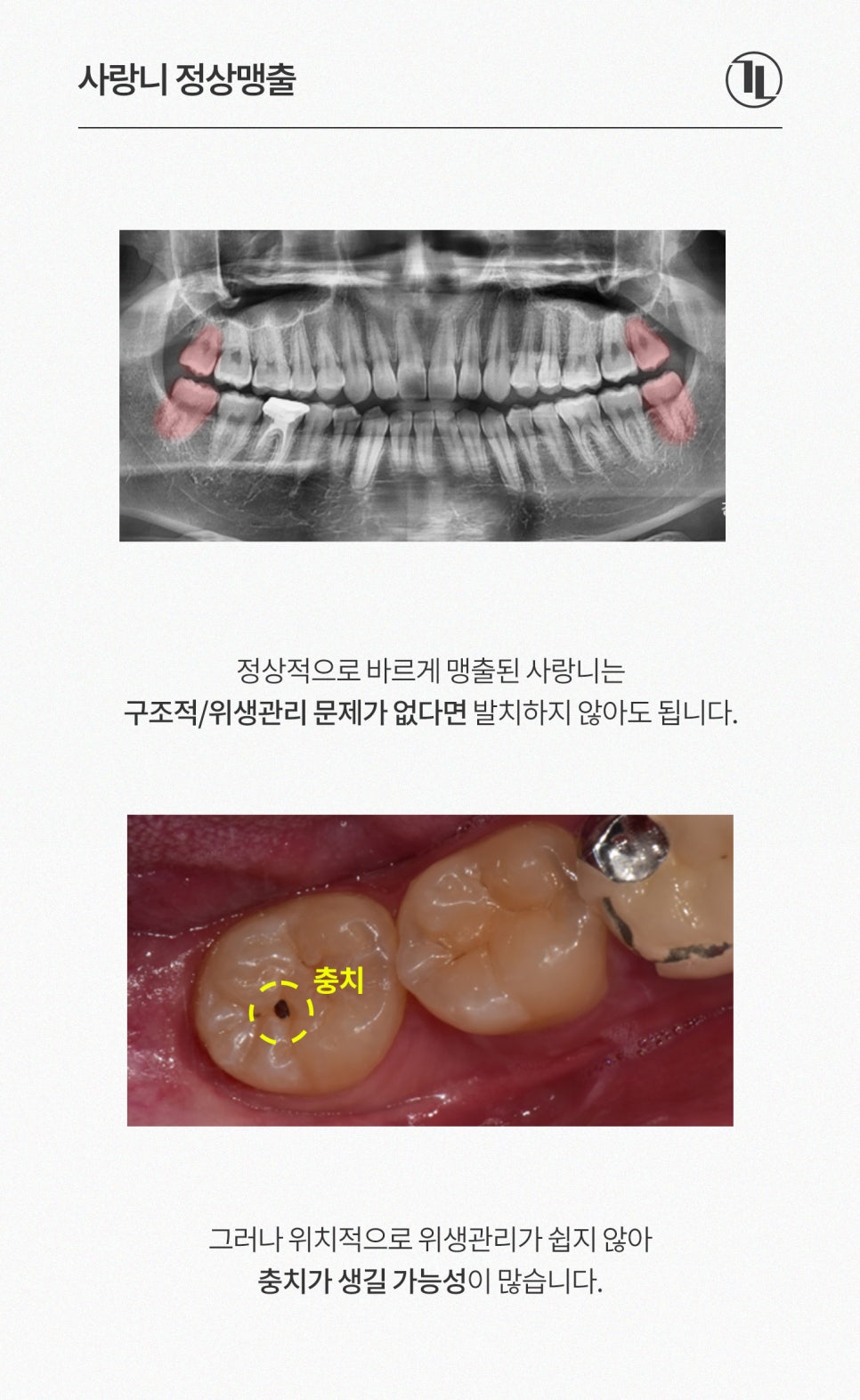 사랑니, 통증 없다고 그냥 둬도 될까? 사랑니의 3가지 사실 / 강남레옹치과 관련 이미지 2