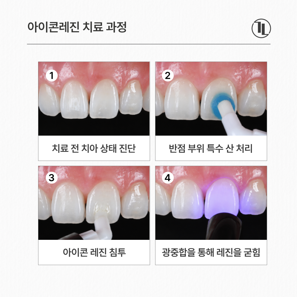앞니 하얀 얼룩, 반점치 치료 케이스 / 아이콘레진 치료 방법 / 강남레옹치과 관련 이미지 5