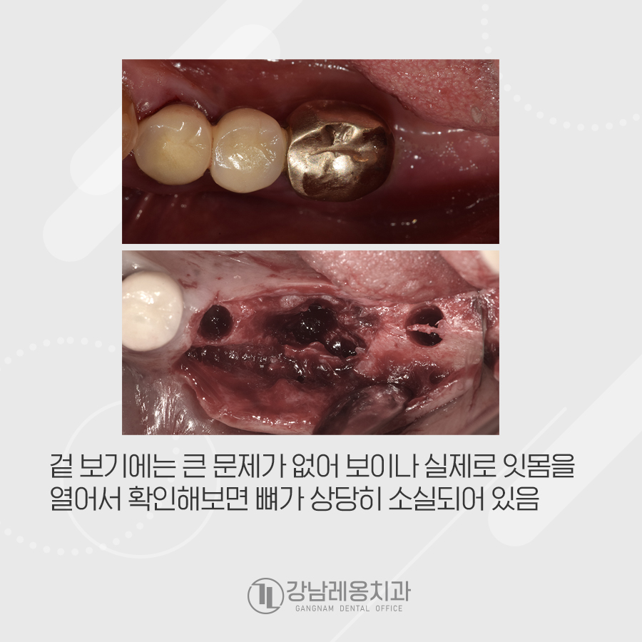 멀쩡한 줄 알았던 오래된 브릿지, 임플란트 수술한 사연 관련 이미지 3