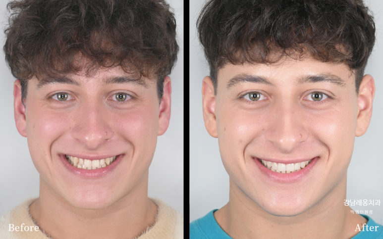 치아가 작아서 콤플렉스? 왜소치 개선 전후 사례👐 / 강남레옹치과 관련 이미지 5