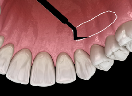 Gum Recession: Can It Expose the Tooth Roots? Before and After Gum Grafting! / Gangnam Leon Dental Clinic image 3