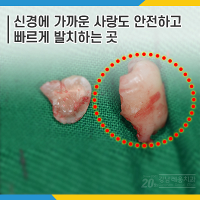 사랑니 발치 전문 레옹의 치료사례, 신경이 가깝거나 멀거나 관련 이미지 8