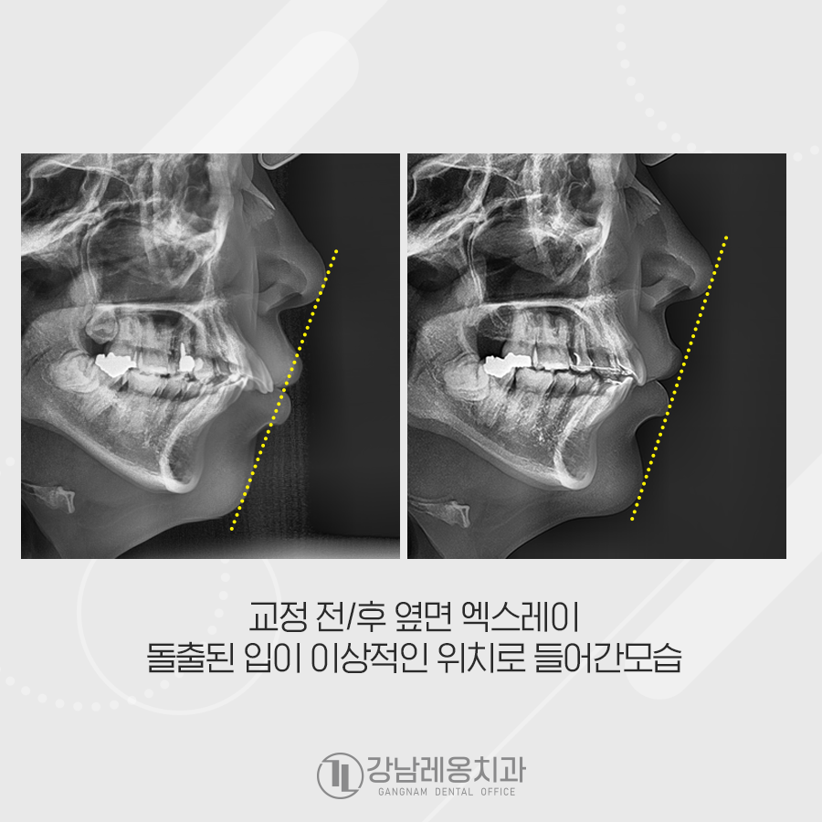 강남레옹치과 치아 교정, 돌출입 두가지 케이스 관련 이미지 3