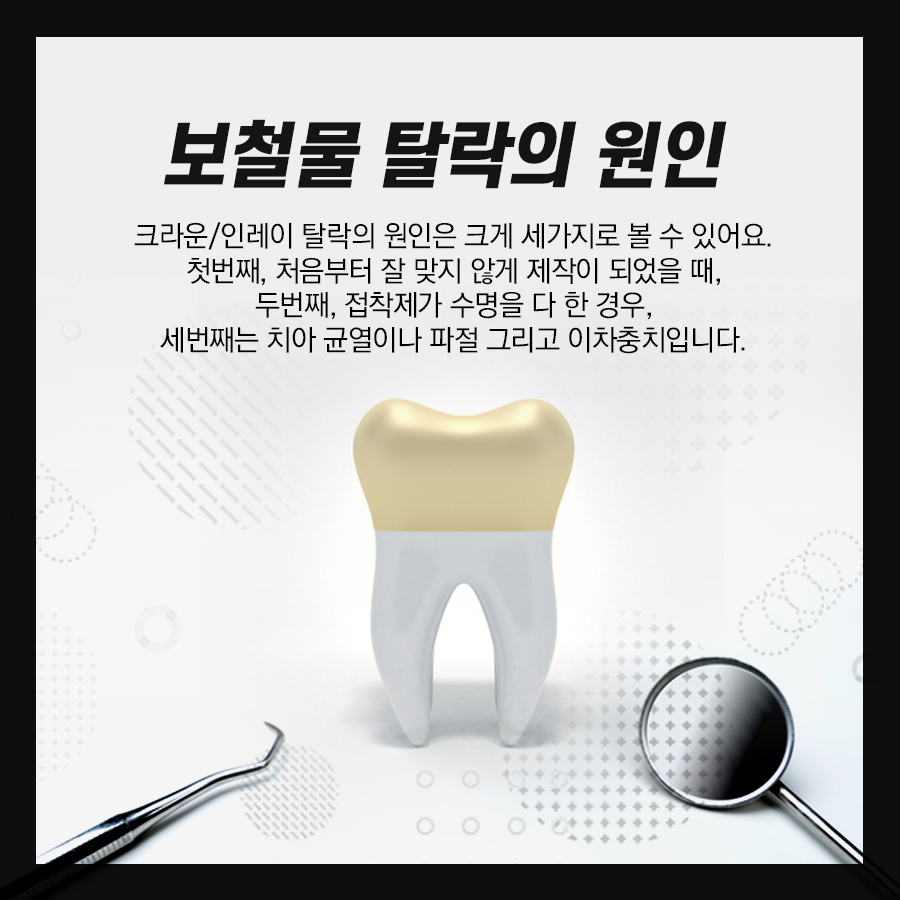 강남역치과 금니 빠짐 원인!? 크라운 / 인레이 탈락 시 대처방법 관련 이미지 3