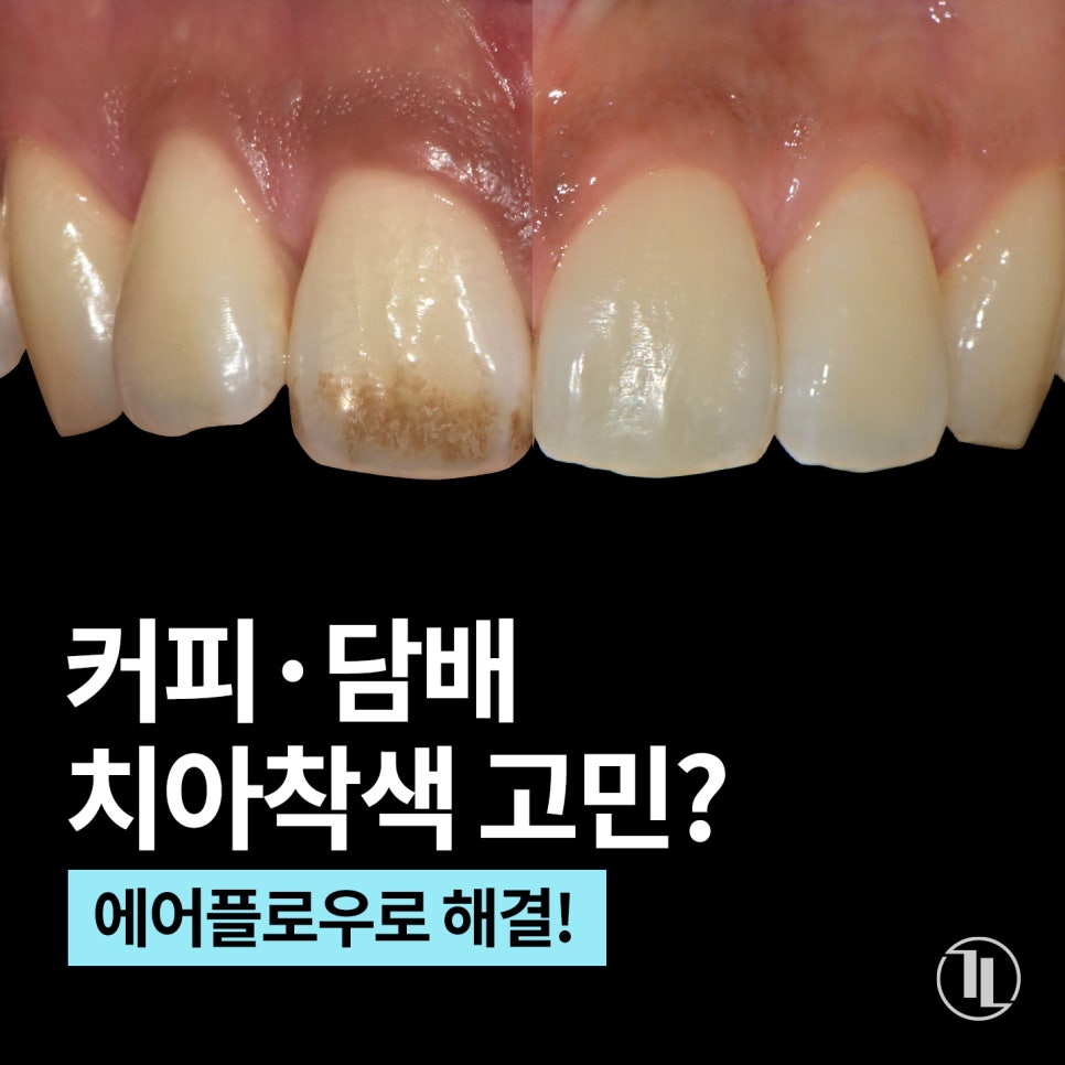 커피&middot;담배치아 착색! 에어플로우로 제거⚡ / 강남레옹치과 관련 이미지 1
